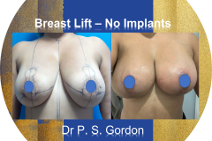 BL-No-Implants-MLPS-M2021