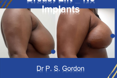 Breast-Lift-No-Implants-NLPS-2021-Pt-1-Right