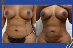 Liposuction-BBPS-Front-HD1