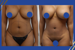 Liposuction-BBPS-Front-HD2