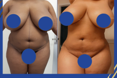 Liposuction-BBPS-Front-PT-3