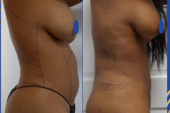 Liposuction-BBPS-Right-HD2
