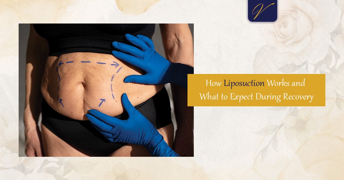 Liposuction
